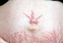 प्रेगनेंसी में स्ट्रेच मार्क्स आए तो क्या करें strech marks